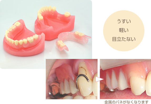 スマイルデンチャー