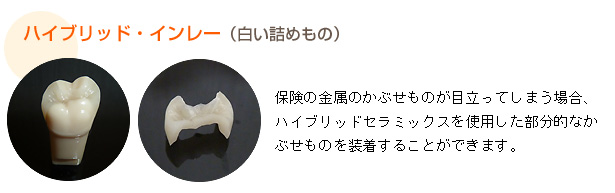 ハイブリッドインレー